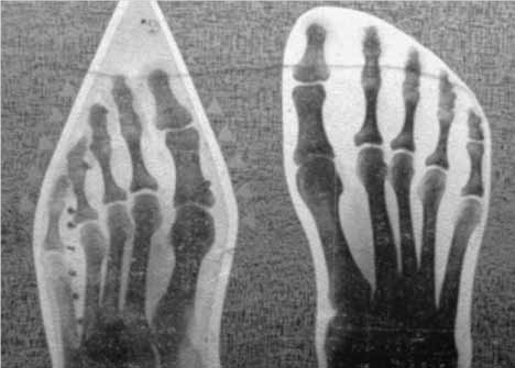Foot xray
